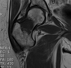 Femoral Neck Metastasis MRI